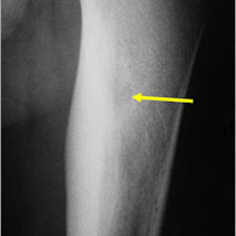 Osteoid8