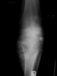 Osteosarcoma Conventional