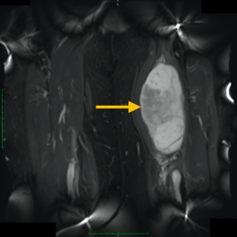 Myxoid Liposarcoma