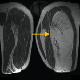 Liposarcoma