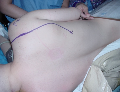 Intra-Op: Incision