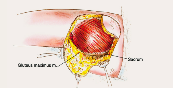 Buttock