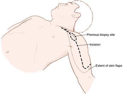 Incision 