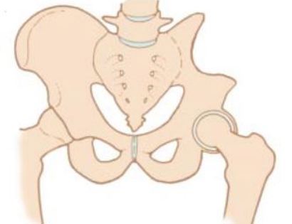 Pelvic Resections