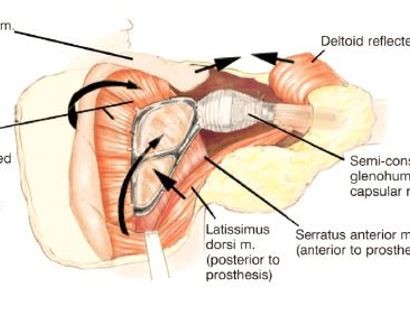 Prosthesis Inserted