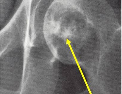X-Ray of Clear Cell Chondrosarcoma
