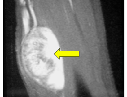 Schwannoma MR