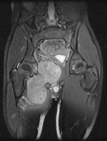 Adductor Compartment Mr