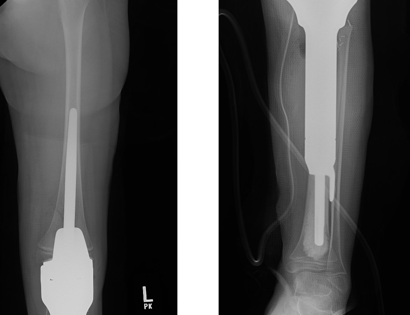 Proximal Tibia X-ray