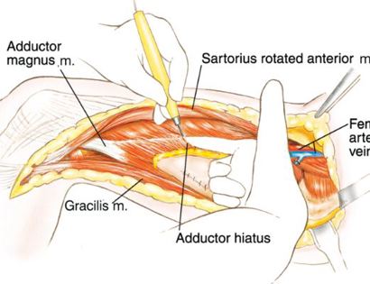 Muscle Release Adductor