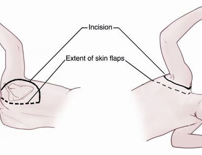 Incision