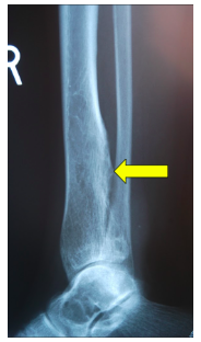 XR Secondary Chondrosarc