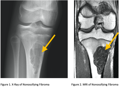 Nonossifying Fibroma