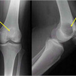 Telangiectatic Osteosarcoma