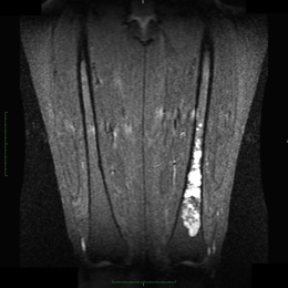 7D) Chondrosarcoma MRI Coronal Stir Of The Left Femur JW2