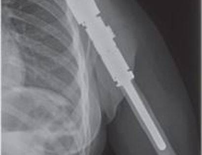X-ray of endoprosthesis 