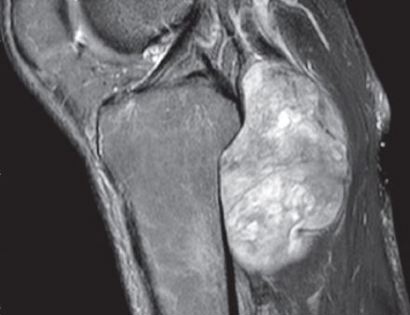 MRI of popliteal tumor 