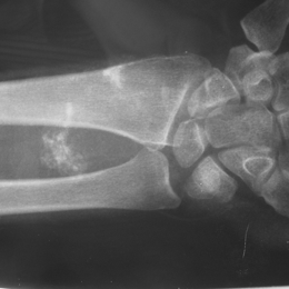 Synovial Sarcoma Of Wrist Area Wit Calcifications