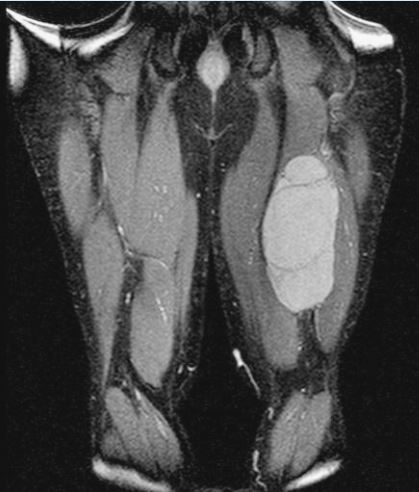 Hamstrings Mri2