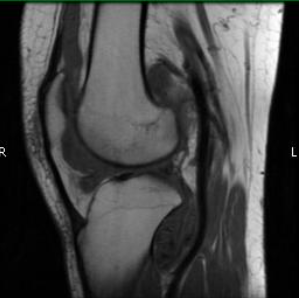 MRI PVNS