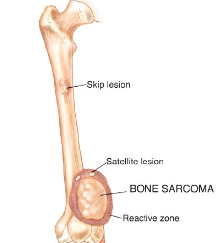 Bone Sarcoma