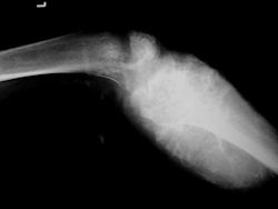 Osteosarcoma Conventional1