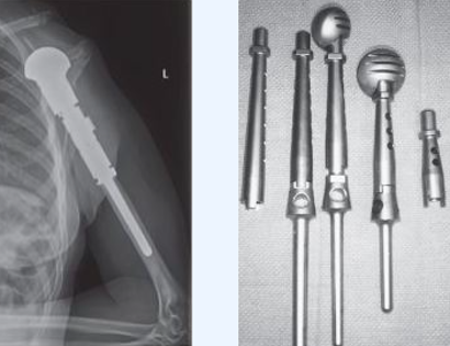 Prosthesis Inserted 