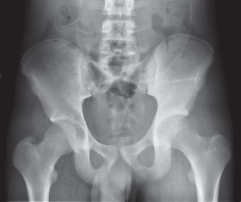 Pelvis Xr