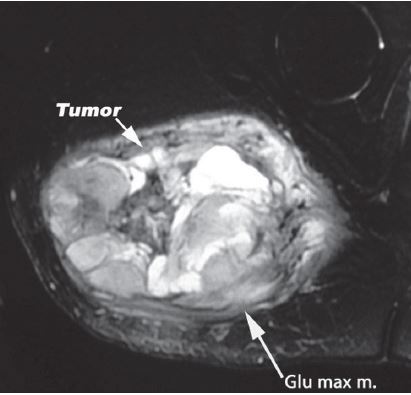 Buttock MRI