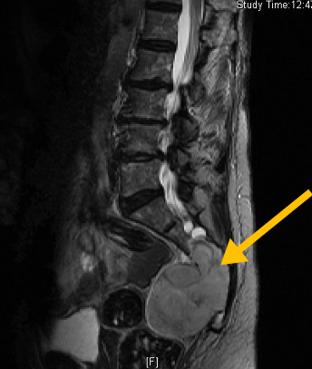 Chordoma