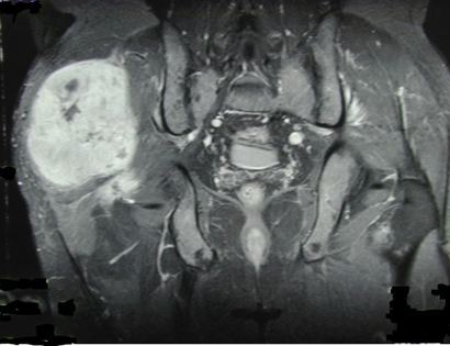 Pre-Op MRI of Tumor 