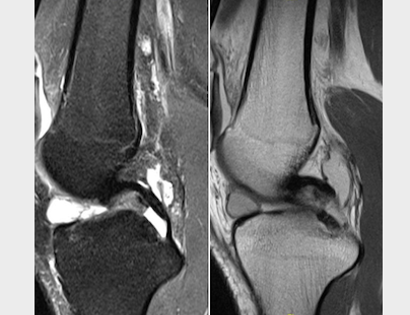 Ganglion Cyst (Perimeniscal Cyst Or ACL Cyst) or Synovial Sarcoma?  The answer is...