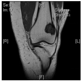 MRI Itraosseous Osteosarcoma