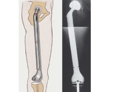 Diagram and X-Ray of Prosthesis Inserted