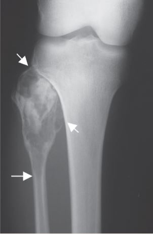 Fibula Xr