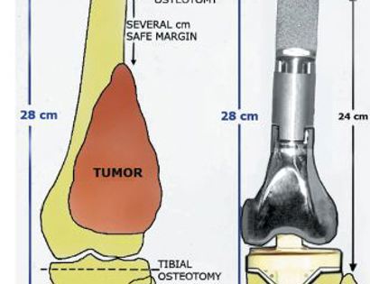 Expandable Prothesis 