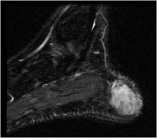 Clear Cell Sarcoma