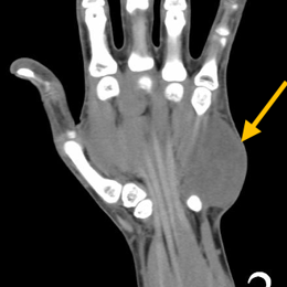 Rhabdomyosarcoma