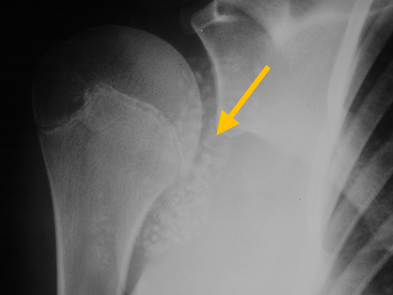 Synovial Chondromatosis1