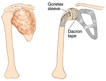 Tumor Removal and Reconstruction 