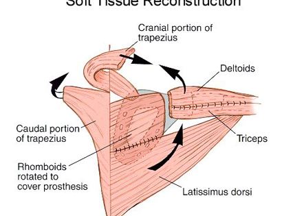 Total Scapula Soft Tissue Reconstruction 