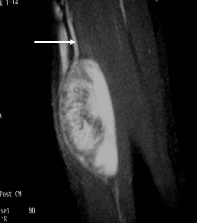 Schwannoma