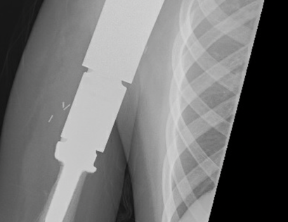 Proximal Humerus X-ray photo