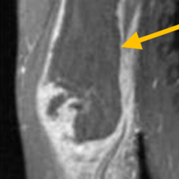 Angiosarcoma