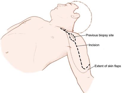 Incision 