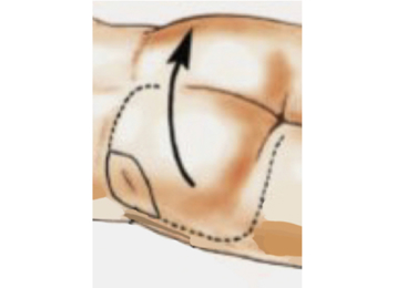 Buttockectomy