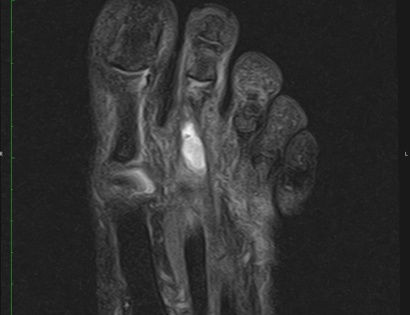 MRI of a Clear Cell Sarcoma