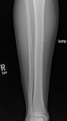 Fibromatosis1