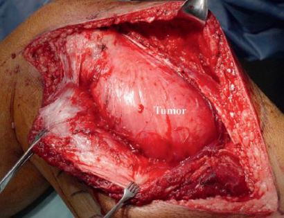 Intra-Operative Tumor