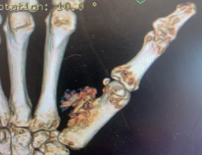 I love hand cases! Interesting rare case! Parosteal osteosarcoma of the first metacarpal? NO! 